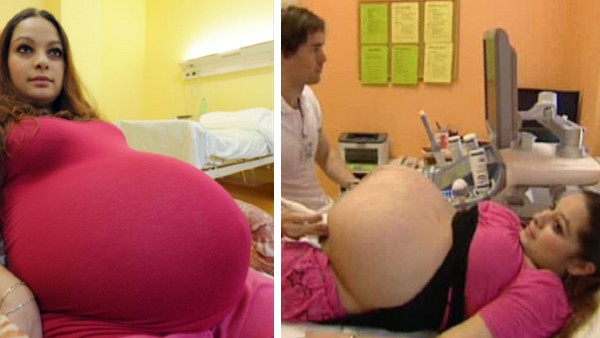Den 23-&aring;riga tjejen trodde att hon var gravid med tvillingar, men&hellip; det h&auml;r intr&auml;ffar bara 1 g&aring;ng p&aring; 480 &aring;r! 1
