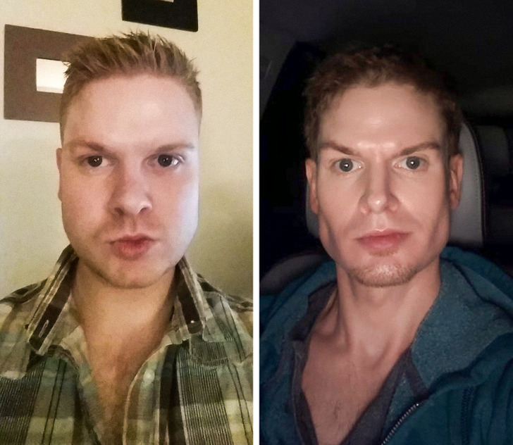 14. Före och efter en näsplastik, hakimplantat och borttagning av ...